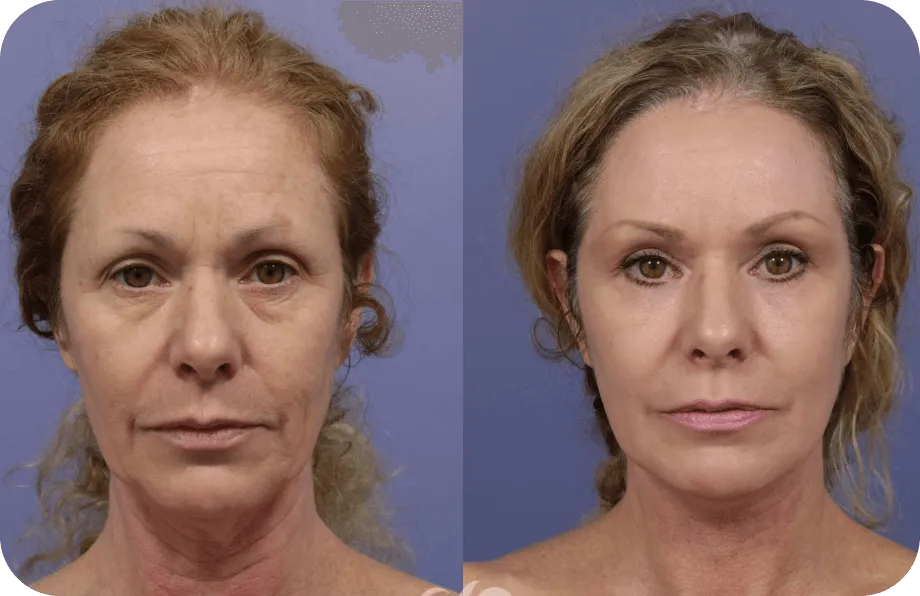 synevra ultralift skin solution